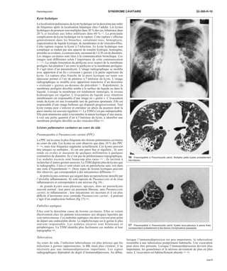 Radiodiagnostic SYNDROME CAVITAIRE 32-360-H-10 
Kyste hydatique 
La localisation pulmonaire du kyste hydatique est la deuxième par ordre 
de fréquence après la localisation hépatique chez l’adulte. Les kystes 
hydatiques du poumon sont multiples dans 30 %des cas, bilatéraux dans 
20 % et localisés aux lobes inférieurs dans 60 % [7]. La principale 
complication du kyste hydatique est la rupture. Cette rupture s’effectue 
généralement dans les bronches, entraînant toux, hémoptysie, 
expectoration de liquide kystique, de membranes et de vésicules-filles. 
Cette rupture expose le kyste à l’infection. Le kyste hydatique non 
compliqué se traduit par une opacité de tonalité hydrique, homogène, 
arrondie ou ovalaire, à contours nets, mesurant de 1 à 20 cmde diamètre. 
Les images cavitaires sont liées à la communication bronchique. Ces 
images sont différentes selon l’importance de cette communication 
[4, 7, 61]. La simple fissuration du périkyste avec respect de la membrane 
proligère fait pénétrer l’air entre le périkyste et la membrane proligère. 
Il s’agit alors d’un pneumokyste. L’image radiographique se modifie 
avec apparition d’un fin « croissant » gazeux à la partie supérieure du 
kyste. La rupture plus franche de la paroi kystique sur toute son 
épaisseur permet à l’air de pénétrer à l’intérieur du kyste. L’image 
radiographique se modifie avec apparition transitoire d’un deuxième 
« croissant » gazeux au-dessous du précédent [7]. Rapidement, la 
membrane proligère décollée tombe à la surface du liquide ou dans le 
liquide. Lorsque la membrane est totalement immergée, le niveau 
hydroaérique est régulier. L’évacuation du liquide avec rétention 
membranaire est responsable d’une image en « grelot ». L’évacuation 
totale du kyste est une éventualité rare de guérison spontanée. Elle est 
responsable d’une image bulleuse qui disparaît progressivement. Tout 
kyste rompu peut s’infecter et entraîner un abcès du poumon dont la 
paroi interne est souvent régulière [61]. LaTDM n’est pas indispensable. 
Elle peut néanmoins aider à reconnaître la nature kystique d’une masse, 
à voir une petite quantité d’air à l’intérieur du kyste, à identifier une 
membrane proligère décollée ou des vésicules-filles [65]. 
Lésions pulmonaires cavitaires au cours du sida 
Pneumopathie à Pneumocystis carinii (PPC) 
La PPC est la cause la plus fréquente des lésions pulmonaires cavitaires 
au cours du sida. Les kystes ne sont observés que dans 10 % des PPC 
[17, 66], mais leur fréquence augmente actuellement. Ces kystes peuvent 
être uniques ou multiples ; ils ont une paroi fine et régulière ; ils sont 
ronds ou ovales et mesurent de quelques millimètres à quelques 
centimètres de diamètre. Ils n’ont pas de prédominance topographique. 
Les nodules excavés sont beaucoup plus rares [45] ; ils incitent à 
rechercher d’autres germes associés. LaTDMdépiste plus de kystes que 
la radiographie. Ceux-ci sont situés soit en parenchyme sain, soit dans 
une zone d’hyperdensité [38]. Deux types de lésions kystiques peuvent 
être observés, qui correspondent à des mécanismes différents [23] : 
– de petits kystes centraux qui siègent dans un parenchyme densifié par 
l’alvéolite inflammatoire. Ils sont tapissés de Pneumocystis et de tissu 
inflammatoire et correspondent à une nécrose (fig 16) ; 
– de grands kystes sous-pleuraux, apicaux, dans un parenchyme 
souvent normal ; leur paroi est purement fibreuse, sans Pneumocystis 
carinii, ni inflammation ; leur mécanisme est incertain et il est plus 
difficile d’incriminer avec certitude Pneumocystis carinii ; il pourrait 
s’agir d’un emphysème bulleux (fig 17) [38]. 
Embolies septiques 
Elles sont la deuxième cause de lésions cavitaires. Elles se voient 
électivement chez les patients toxicomanes aux drogues injectées par 
voie intraveineuse. Ces embolies septiques ont alors souvent pour point 
de départ une endocardite droite. Le staphylocoque est le germe le plus 
souvent responsable. Les nodules excavés sont bilatéraux et 
périphériques. La TDM identifie plus facilement ces nodules et leur 
topographie [40]. 
Tuberculose 
Au cours du sida, l’infection tuberculeuse est plus précoce que les 
infections à germes opportunistes, le BK étant plus virulent, il ne 
nécessite pas une immunodépression importante. Les signes 
radiographiques dépendent du degré d’immunodépression. Au début, 
16 Pneumopathie à Pneumocystis carinii. Multiples petits kystes probablement 
nécrotiques. 
17 Pneumopathie à Pneumocystis carinii. Kystes sous-pleuraux à parois fines 
correspondant probablement à des lésions d’emphysème paraseptal. 
lorsque l’immunodépression est peu importante, la tuberculose 
ressemble à une tuberculose postprimaire habituelle. Une excavation 
peut alors être présente. Lorsque l’immunodépression devient plus 
importante, les granulomes et la nécrose deviennent de plus en plus 
rares. L’excavation est habituellement absente [32, 60]. 
page 9 
 