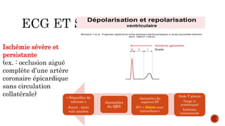 Onde T géante
(large et
symétrique)
Ischémie
transmurale
Anomalies
du QRS
Anomalies du
segment ST
ST+ « lésion sous-
épicardique »
« Séquelles de
nécrose »
Jours , mois
voir années
Ischémie sévère et
persistante
(ex. : occlusion aiguë
complète d’une artère
coronaire épicardique
sans circulation
collatérale)
 