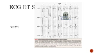 Cath lab
Thrombolyse
Quiz ECG
 