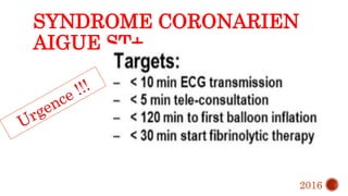 SYNDROME CORONARIEN
AIGUE ST+
2016
 