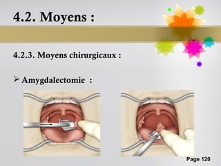 4.2. Moyens :

4.2.3. Moyens chirurgicaux :

 Amygdalectomie :




                               Page 120
 