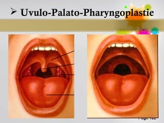  Uvulo-Palato-Pharyngoplastie




                          Page 122
 