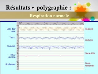 Résultats ► polygraphie :
         Respiration normale




                               Page 89
 