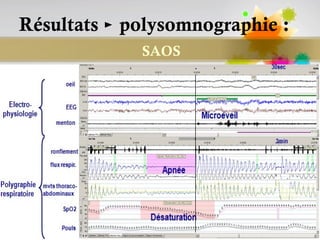 Résultats ► polysomnographie :
             SAOS




                           Page 92
 