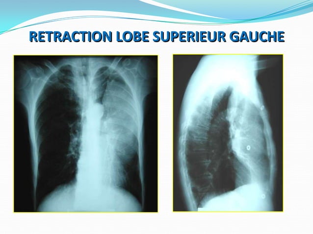 Qu’Est-Ce Que La Condensation Pulmonaire Systématisée Rétractée – RGNM