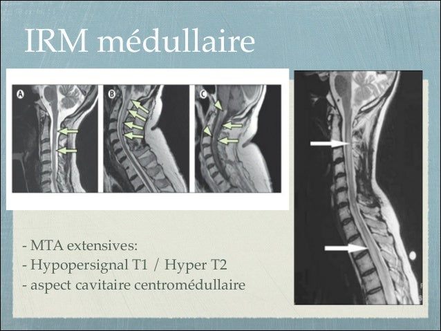 Nmo Neuromyelite Optique Syndrome De Devic