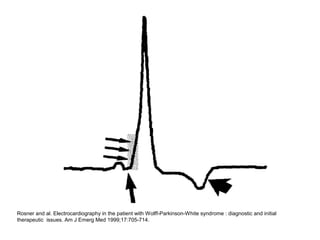 Rosner and al. Electrocardiography in the patient with Wolff-Parkinson-White syndrome : diagnostic and initial
therapeutic issues. Am J Emerg Med 1999;17:705-714.
 