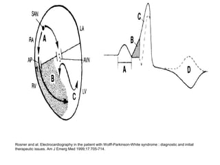 Rosner and al. Electrocardiography in the patient with Wolff-Parkinson-White syndrome : diagnostic and initial
therapeutic issues. Am J Emerg Med 1999;17:705-714.
 