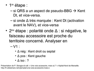 Présentation de P. Sbragia et coll. « Une voie accessoire, mais où ? » hôpital Nord de Marseille.
http://fr.slideshare.net/vjtemplar/une-voie-accessoire-mais-o
• 1ère
étape :
– si QRS a un aspect de pseudo-BBG  Kent
Dt, et vice-versa.
– si onde Δ très marquée : Kent Dt (activation
avant le NAV), et vice-versa
• 2ème
étape : polarité onde Δ : si négative, le
faisceau accessoire est proche du
territoire concerné. Analyser en
– V1 :
• Δ nég : Kent droit ou septal
• Δ pos : Kent gauche
• Δ iso : ?
 