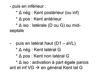 - puis en inférieur :
* Δ nég : Kent postérieur (ou inf)
* Δ pos : Kent antérieur
* Δ iso : latérale (D ou G) ou mid-
septale
- puis en latéral haut (D1 – aVL)
* Δ nég : Kent latéral G
* Δ pos : Kent non latéral G
* Δ iso : activation à part égale parois
ant et inf VG  en général Kent lat G
 