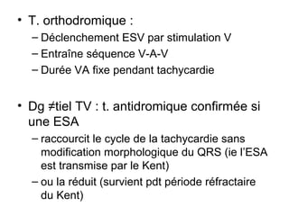 • T. orthodromique :
– Déclenchement ESV par stimulation V
– Entraîne séquence V-A-V
– Durée VA fixe pendant tachycardie
• Dg ≠tiel TV : t. antidromique confirmée si
une ESA
– raccourcit le cycle de la tachycardie sans
modification morphologique du QRS (ie l’ESA
est transmise par le Kent)
– ou la réduit (survient pdt période réfractaire
du Kent)
 