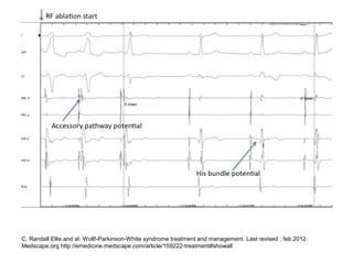 C. Randall Ellis and al. Wollf-Parkinson-White syndrome treatment and management. Last revised : feb.2012.
Medscape.org http://emedicine.medscape.com/article/159222-treatment#showall
 