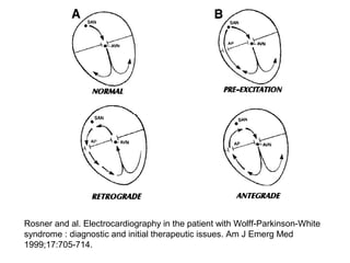 Rosner and al. Electrocardiography in the patient with Wolff-Parkinson-White
syndrome : diagnostic and initial therapeutic issues. Am J Emerg Med
1999;17:705-714.
 