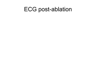 ECG post-ablation
 