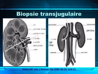 Biopsie transjugulaire
Stiles KP, Am J Kidney Dis 2000 36 (2): 419-33
 