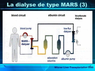 La dialyse de type MARS (3)
Mitzner Liver Transplantation 2000
 