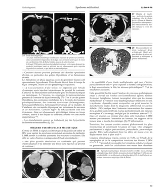Radiodiagnostic Syndrome médiastinal 32-360-P-10 
*A *B 
– Certaines masses peuvent présenter des densités spontanées 
élevées, en particulier des goitres thyroïdiens et les hématomes 
récents. 
Les hématomes en phase aiguë (au cours des premières heures) sont 
spontanément hyperdenses. Cette densité décroît dans le temps de 
façon centripète, créant un halo périphérique hypodense. 
– La vascularisation d’une lésion est appréciée par l’étude 
dynamique après injection intraveineuse de produit de contraste. 
L’absence de rehaussement est habituelle pour les lésions kystiques 
ou nécrotiques. À l’inverse, les structures hypervascularisées 
prennent le contraste de façon intense (fig 27). C’est le cas des goitres 
thyroïdiens, des carcinomes médullaires de la thyroïde, des tumeurs 
parathyroïdiennes, des tumeurs vasculaires (hémangiomes, 
hémangioépithéliomes, hémangiopéricytomes), de la maladie de 
Castelman, des carcinoïdes thymiques, des métastases de sarcomes 
et de mélanomes. Certains types de rehaussement sont très 
évocateurs. Ainsi un rehaussement périphérique intense au temps 
veineux, associé à des flaques de contraste, oriente vers une masse 
angiomateuse [55]. 
– Les épanchements gazeux se traduisent par des hyperclartés 
facilement reconnaissables (fig 28). 
IMAGERIE PAR RÉSONANCE MAGNÉTIQUE 
Comme en TDM, le signal caractéristique de la graisse est utilisé en 
IRM pour repérer les structures normales et anormales du médiastin. 
L’IRM permet la visibilité spontanée des structures vasculaires. Elle 
offre en outre d’autres avantages dans l’étude du médiastin : 
– une plus grande résolution en contraste qui permet 
d’individualiser et de délimiter une lésion sans injection de produit 
de contraste ; 
– la possibilité d’une étude multiplanaire qui peut s’avérer 
particulièrement utile [62] pour explorer la fenêtre aortopulmonaire, 
la loge sous-carinaire, le hile, les récessus péricardiques [22, 30] et les 
structures vasculaires. 
Cette possibilité facilite aussi l’analyse de processus pathologiques 
situés à cheval sur l’orifice cervicomédiatinal (goitre, tumeur 
thymique, lymphome, tumeur neurogène) ainsi que les masses 
médiastinales à extension sous-diaphragmatique (thymome invasif, 
lymphome, dysembryome) auxquelles on peut associer le 
mésothéliome malin dont le diagnostic différentiel est parfois 
difficile. L’IRM analyse bien l’extension intracanalaire des tumeurs 
de la gouttière costovertébrale et, plus particulièrement, des tumeurs 
neurogènes. Cet avantage, souligné par de nombreux auteurs [18, 62], 
place cet examen au premier plan dans cette indication. L’IRM 
montre parfaitement l’extension en hauteur, les rapports de la 
tumeur avec la moelle, les méninges (fig 29) et les racines. 
Toutefois, les coupes axiales restent globalement les plus 
informatives et constituent l’examen de base. Elles dégagent 
parfaitement la région prévasculaire, prétrachéale, para-aortique 
gauche. Elles individualisent bien les effets de masse avec les 
déplacements dans le plan axial [4]. 
L’analyse sémiologique repose, comme en TDM, sur l’étude de la 
topographie et de la composition tissulaire des lésions. L’IRM 
[23, 24, 36, 40, 61] permet de reconnaître les formations solides, kystiques 
ou graisseuses ; mais les calcifications sont moins bien identifiées 
25 Kyste bronchogénique. 
A. Coupe tomodensitométrique (TDM) sans injection de produit de contraste : 
masse spontanément hyperdense de la loge sous-carinaire (astérisque). Il existe 
des calcifications (tête de flèche) visibles au sein de cette structure. 
B. Coupe TDM après injection de produit de contraste : cette masse demeure hy-perdense 
(astérisque) mais ne présente pas de rehaussement après injection 
de produit de contraste, ce qui atteste sa nature kystique. 
26 Kyste pleuropéricardique. Tomodensitométrie (TDM) : masse de l’angle 
cardiophrénique droit (étoile), homogène de densité hydrique (5 UH) sans pa-roi 
identifiable (A) se déformant en décubitus latéral (B) et dont l’attache an-térieure 
présente un angle aigu (tête de flèche). 
*A 
*B 
27 Maladie de Castle-man 
: multiples formations 
nodulaires (tête de flèche) 
de 10 à 15 mm de diamètre 
évoquant des adénopathies ; 
fort rehaussement en den-sité 
analogue à celui des 
vaisseaux. 
28 Pneumomédiastin (at-teinte 
pulmonaire d’une 
sclérodermie). Clartés aéri-ques 
décollant la plèvre mé-diastinale 
et disséquant la 
graisse médiastinale. 
13 
 