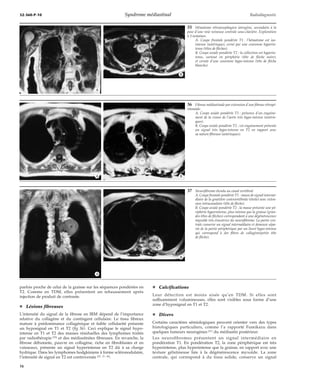 32-360-P-10 Syndrome médiastinal Radiodiagnostic 
parfois proche de celui de la graisse sur les séquences pondérées en 
T2. Comme en TDM, elles présentent un rehaussement après 
injection de produit de contraste. 
¦ Lésions fibreuses 
L’intensité du signal de la fibrose en IRM dépend de l’importance 
relative du collagène et du contingent cellulaire. Le tissu fibreux 
mature à prédominance collagénique et faible cellularité présente 
un hyposignal en T1 et T2 (fig 36). Ceci explique le signal hypo-intense 
en T1 et T2 des masses résiduelles des lymphomes traités 
par radiothérapie [25] et des médiastinites fibreuses. En revanche, la 
fibrose débutante, pauvre en collagène, riche en fibroblastes et en 
vaisseaux, présente un signal hyperintense en T2 dû à sa charge 
hydrique. Dans les lymphomes hodgkiniens à forme scléronodulaire, 
l’intensité de signal en T2 est controversée [25, 37, 46]. 
35 Hématome rétrooesophagien iatrogène, secondaire à la 
pose d’une voie veineuse centrale sous-clavière. Exploration 
à 3 semaines. 
A. Coupe frontale pondérée T1 : l’hématome est iso-intense 
(astérisque), cerné par une couronne hyperin-tense 
(têtes de flèches). 
B. Coupe axiale pondérée T2 : la collection est hyperin-tense, 
surtout en périphérie (tête de flèche noire), 
et cernée d’une couronne hypo-intense (tête de flèche 
blanche). 
¦ Calcifications 
Leur détection est moins aisée qu’en TDM. Si elles sont 
suffisamment volumineuses, elles sont visibles sous forme d’une 
zone d’hyposignal en T1 et T2. 
¦ Divers 
Certains caractères sémiologiques peuvent orienter vers des types 
histologiques particuliers, comme l’a rapporté Fumikazu dans 
quelques tumeurs neurogènes [21] du médiastin postérieur. 
Les neurofibromes présentent un signal intermédiaire en 
pondération T1. En pondération T2, la zone périphérique est très 
hyperintense, plus hyperintense que la graisse, en rapport avec une 
texture gélatineuse liée à la dégénérescence myxoïde. La zone 
centrale, qui correspond à du tissu solide, conserve un signal 
*A 
*B 
36 Fibrose médiastinale par extension d’une fibrose rétropé-ritonéale. 
A. Coupe axiale pondérée T1 : présence d’un engaine-ment 
de la crosse de l’aorte très hypo-intense (astéris-ques). 
B. Coupe axiale pondérée T2 : cet engainement présente 
un signal très hypo-intense en T2 en rapport avec 
sa nature fibreuse (astérisques). 
*A *B 
37 Neurofibrome étendu au canal vertébral. 
A. Coupe frontale pondérée T1 : masse de signal intermé-diaire 
de la gouttière costovertébrale (étoile) avec exten-sion 
intracanalaire (tête de flèche). 
B. Coupe axiale pondérée T2 : la masse présente une pé-riphérie 
hyperintense, plus intense que la graisse (gran-des 
têtes de flèches) correspondant à une dégénérescence 
myxoïde très évocatrice du neurofibrome. La partie cen-trale 
conserve un signal intermédiaire et demeure sépa-rée 
de la partie périphérique par un liseré hypo-intense 
qui correspond à des fibres de collagène(petite tête 
de flèche). 
*A 
*B 
16 
 