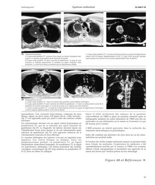 Radiodiagnostic Syndrome médiastinal 32-360-P-10 
*A 
*A *B 
intermédiaire. Une couronne hypo-intense, composée de tissu 
fibreux, sépare ces deux zones. Cet aspect dit en « cible inversée » 
(fig 37) est opposable point par point à celui des tumeurs solides 
nécrosées. 
Les schwannomes nécrosés ont un signal central hyperintense en 
pondération T2, qui ne se rehausse pas après injection de 
gadolinium (fig 38). Le diagnostic de tumeur nécrosée repose sur 
l’identification d’une paroi épaisse et de son rehaussement après 
injection de gadolinium (fig 39). Une approche indirecte de la 
vascularisation tumorale est ainsi effectuée. 
Le caractère hétérogène des tumeurs n’est pas un argument pour 
apprécier leur nature bénigne ou maligne. Ainsi, les 
ganglioneuromes gardent, en pondération T1, un signal 
intermédiaire relativement homogène. En pondération T2, le signal 
est hyperintense, hétérogène. Ces lésions présentent des lamelles 
curvilignes concentriques (fig 40) hypo-intenses en pondération T1 
et T2, dues aux fibres de collagène. 
Outre le bilan d’extension des tumeurs de la gouttière 
costovertébrale où l’IRM se place en première intention après la 
radiographie standard, les autres indications de l’IRM sont des cas 
particuliers où une information sur la nature ou l’extension n’a pas 
été fournie par le scanner. 
L’IRM présente un intérêt particulier dans la recherche des 
extensions intracardiaques ou péricardiques. 
Enfin, elle constitue une alternative de choix dans les cas de contre-indication 
aux produits iodés. 
Si l’analyse des clichés simples représente toujours la première étape 
dans l’étude du médiastin, l’exploration du médiastin a été 
considérablement enrichie par le scanner et l’IRM. Ces examens 
affinent l’étude topographique et permettent une approche de la 
nature des lésions par l’analyse précise de leur sémiologie. 
Figure 40 et Références ä 
38 Schwannome kystique. 
A. Coupe axiale pondérée T1 : présence d’une masse iso-intense, homogène (asté-risque), 
en situation paratrachéale droite laminant la trachée. 
B. Coupe axiale pondérée T1 après injection de gadolinium : la paroi de cette 
structure se rehausse massivement et présente un aspect irrégulier (têtes 
de flèches). Le centre de la lésion ne présente pas de rehaussement notable. 
*B *C 
C. Coupe axiale pondérée T2 : le centre de la lésion présente un signal très hyperintense 
comme celui du liquide céphalorachidien (LCR). Il s’agit d’une structure kystique 
à paroi épaisse avec présence d’un niveau liquide-liquide (têtes de flèches). 
39 Paragangliome nécrosé. 
A. Coupe axiale pondérée T1 : masse iso-intense de la gouttière costovertébrale (astérisque). 
B. Coupe axiale pondérée T1 après injection de chélate de gadolinium : il existe un rehaussement massif de la 
périphérie de la lésion (astérisque). Le centre de la masse ne se rehausse pas (tête de flèche). 
C. Coupe coronale pondérée T2 : le centre de la lésion kystisée présente un signal très hyperintense (astérisque) 
comme le liquide céphalorachidien (LCR) (tête de flèche). 
*C 
17 
 