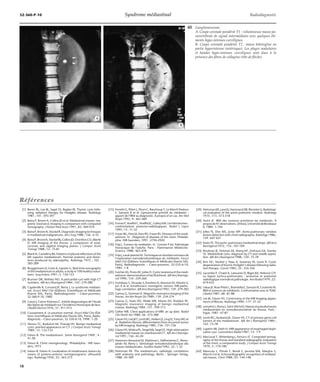 32-360-P-10 Syndrome médiastinal Radiodiagnostic 
Références 
[1] Baron RL, Lee JK, Sagel SS, Baglan RJ. Thymic cysts follo-wing 
radiation therapy for Hodgkin disease. Radiology 
1981 ; 141 : 593-597 
[2] Batra P, Brown K, Collins JD et al. Mediastinal masses: ma-gnetic 
resonance imaging in comparison with computed 
tomography. J Nation Med Assoc 1991 ; 83 : 969-974 
[3] Batra P,BrownK, Steckel R. Diagnosticimagingtechniques 
in mediastinal malignancies. Am J Surg 1988 ; 156 : 4-10 
[4] Batra P,BrownK, Steckel RJ, Collins JD,OvenforsCO,Aberle 
D. MR imaging of the thorax: a comparison of axial, 
coronal, and sagittal imaging planes. J Comput Assist 
Tomogr 1988 ; 12 : 75-81 
[5] Blank N, Castellino RA. Patterns of pleural reflections of the 
left superior mediastinum. Normal anatomy and distor-tions 
produced by adenopathy. Radiology 1972 ; 102 : 
585-589 
[6] Bruggemann A, Greie A, Lepsien G. Real-time sonography 
of the mediastinum in adults; a study in 100 healthy volun-teers. 
Surg Endosc 1991 ; 5 : 150-153 
[7] Brunner DR, Withley NO. A pericardial cyst with high CT 
numbers. AJR Am J Roentgenol 1984 ; 142 : 279-280 
[8] Capdeville R, Convard JP, Remy J. Le syndrome médiasti-nal. 
Encycl Méd Chir (Éditions Scientifiques et Médicales 
Elsevie SAS, Paris), Radiodiagnostic – Coeur-poumon, 
32-360-P-10, 1980 
[9] Caron J, Caron-Poitreau C. Intérêt diagnostique de l’étude 
des lignes du médiastin sur l’incidence thoracique de face. 
J Radiol Electrol 1976 ; 57 : 911-915 
[10] Coussement A. Le poumon normal. Encycl Méd Chir (Édi-tions 
Scientifiques et Médicales Elsevie SAS, Paris), Radio-diagnostic 
– Coeur-poumon, 32-330-A-10, 1998 : 1-20 
[11] Demos TC, Budorick NE, Posniak HV. Benign mediastinal 
cysts: pointed appearance on CT. J Comput Assist Tomogr 
1989 ; 13 : 132-133 
[12] Felson B. The mediastinum. Semin Roentgenol 1969 ; 4 : 
41-58 
[13] Felson B. Chest roentgenology. Philadelphia : WB Saun-ders, 
1973 
[14] Felson B, Felson H. Localization of intrathoracic lesions by 
means of postero-anterior roentgenograms: silhouette 
sign. Radiology 1950 ; 55 : 363-373 
40 Ganglioneurome. 
[15] Ferretti G, Pittet L, Pison C, Ranchoup Y, Le March’Hadour 
F, Sarrazin R et al. Liposarcome primitif du médiastin : 
apport de l’IRM au diagnostic. À propos d’un cas. Rev Mal 
Respir 1992 ; 9 : 467-469 
[16] Fornes P,Hoeffel C,Hoeffel JC, GalloyMA.Leshématomes: 
confrontations anatomo-radiologiques. Radiol J Cepur 
1995 ; 15 : 11-32 
[17] Fraser RG, Pare JA, Pare PD, Fraser RS. Diseases of the medi-astinum. 
In : Diagnosis of diseases of the chest. Philadel-phia 
:WB Saunders, 1991 : 2794-2920 
[18] Frija J. Tumeur du médiastin. In : Grenier P éd. Pathologie 
thoracique de l’adulte. Paris : Flammarion Médecine- 
Science, 1988 : 463-478 
[19] Frija J, Laval-JeantetM.Techniques et résultatsnormauxde 
l’exploration tomodensitométrique du médiastin. Encycl 
Méd Chir (Éditions Scientifiques et Médicales Elsevie SAS, 
Paris), Radiodiagnostic – Coeur-poumon, 32-535-A-10, 
1985 : 1-8 
[20] Fulcher AS, Proto AV, Jolles H. Cystic teratoma of the medi-astinum: 
demonstration of fat/fluid level. AJRAmJ Roentge-nol 
1990 ; 154 : 259-260 
[21] Fumikazu S, Shusuke S, Kunihiro K, Atsunori M, Hitoshi U, 
Jun A et al. Intrathoracic neurogenic tumors: MR-patho-logic 
correlation. AJRAmJ Roentgenol 1992 ; 159 : 279-283 
[22] Gamsu G, Sostman D. Magnetic resonance imaging of the 
thorax. Am Rev Respir Dis 1989 ; 139 : 254-274 
[23] Gamsu G, Stark DD, Webb WR, Moore EH, Sheldon PE. 
Magnetic resonance imaging of benign mediastinal 
masses. Radiology 1984 ; 151 : 709-713 
[24] Gefter WB. Chest applications of MRI: an up date. Radiol 
Clin North Am 1988 ; 26 : 573-588 
[25] Glazer HS, Lee JKT, LevittRG,Heiken JS, Ling D, TottyWGet 
al . Radiation fibrosis: differentiation from recurrent tumor 
by MR imaging. Radiology 1985 ; 156 : 721-726 
[26] GlazerHS,MolinaPL, SiegelMJ,Sagel SS. High-attenuation 
mediastinal masses on unenhanced CT. AJR Am J Roentge-nol 
1991 ; 156 : 45-50 
[27] Hammon-Kerautret M, Wattinne L, Deffontaines C, Remy- 
Jardin M, Remy J. Sémiologie tomodensitométrique des 
masses médiastinales. Feuillets Radiol 1992 ; 32 : 1-32 
[28] Heitzman ER. The mediastinum: radiologic correlations 
with anatomy and pathology. Berlin : Springer Verlag, 
1988 : 45-309 
A. Coupe coronale pondérée T1 : volumineuse masse pa-ravertébrale 
de signal intermédiaire avec quelques élé-ments 
hypo-intenses curvilignes. 
B. Coupe coronale pondérée T2 : masse hétérogène en 
partie hyperintense (astérisque). Les plages nodulaires 
et bandes hypo-intenses curvilignes sont dues à la 
présence des fibres de collagène (tête de flèche). 
[29] HeitzmanER,LaneEJ,HammackDB,RimmlerLJ. Radiologi-cal 
evaluation of the aortic-pulmonic window. Radiology 
1975 ; 115 : 513-518 
[30] Hutin JF. IRM des tumeurs primitives du médiastin. À 
proposde41observations. [thèse], UniversitédeBordeaux 
II, 1989 : 1-194 
[31] Jolles PJ, Shin MS, Jones WP. Aorto-pulmonary window 
lesions detection with chest radiography. Radiology 1986 ; 
159 : 647-651 
[32] Keats TE. The aortic-pulmonary mediastinal stripe. AJRAmJ 
Roentgenol 1972 ; 116 : 107-109 
[33] Khulman JE, Fishman EK, Wang KP, Zerhouni EA, Stanley 
SS. Mediastinal cysts: diagnosis by CT and needle aspira-tion. 
AJR Am J Roentgenol 1988 ; 150 : 75-78 
[34] Kim HC, Nosher J, Haas A, Sweeney W, Lewis R. Cystic 
degeneration of thymic Hodgkin’s disease following radia-tion 
therapy. Cancer 1985 ; 55 : 354-356 
[35] Lacombe P, Chatel A, Latouche D, Bigot JM, Helenon CH. 
La région aortico-pulmonaire : anatomie et anatomie 
radiologique normale et pathologie. Ann Radiol1979 ; 22 : 
619-633 
[36] Lebas JF, Rose Pittet L, Brambilla E, Sarrazin R, Coulomb M. 
IRM et tumeurs du médiastin. Confrontation avec la TDM. 
J Radiol 1987 ; 68 : 81-88 
[37] Lee JK, Glazer HS. Controversy in the MR Imaging appea-rance 
of fibrosis. Radiology 1990 ; 177 : 21-22 
[38] Lemaitre L,RemyJ, Saint-Michel J.Massesetpseudomasses 
médiastinales en tomodensitométrie du thorax. Paris : 
Vigot, 1987 : 47-87 
[39] Levitt RG, Husband JE, Glazer HS. CT of primary germ-cell 
tumors of the mediastinum. AJR Am J Roentgenol 1984 ; 
142 : 73-78 
[40] Lupetin AR, Dash N. MRI appearance of esophageal dupli-cation 
cyst. Gastrointest Radiol 1987 ; 12 : 7-9 
[41] MacLoud T, Wittenberg J, Ferrucci JT. Computed tomog-raphy 
of the thorax and standard radiographic evaluation 
of the chest: a comparative study. J Comput Assist Tomogr 
1979 ; 3 : 170-180 
[42] Mancuso L, Pitrolo F, Bondi F, Jacoma MA, Margins S, 
Marchi S et al. Echocardiographic recognition of mediasti-nal 
masses. Chest 1988 ; 93 : 144-148 
*A 
*B 
18 
 