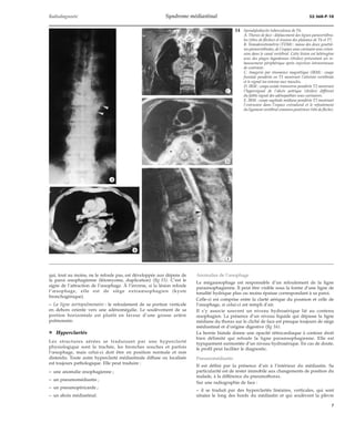 Radiodiagnostic Syndrome médiastinal 32-360-P-10 
qui, tout au moins, ne le refoule pas, est développée aux dépens de 
la paroi oesophagienne (léiomyome, duplication) (fig 15). C’est le 
signe de l’attraction de l’oesophage. À l’inverse, si la lésion refoule 
l’oesophage, elle est de siège extraoesophagien (kyste 
bronchogénique). 
– La ligne aortopulmonaire : le refoulement de sa portion verticale 
en dehors oriente vers une adénomégalie. Le soulèvement de sa 
portion horizontale est plutôt en faveur d’une grosse artère 
pulmonaire. 
¦ Hyperclartés 
Les structures aérées se traduisant par une hyperclarté 
physiologique sont la trachée, les bronches souches et parfois 
l’oesophage, mais celui-ci doit être en position normale et non 
distendu. Toute autre hyperclarté médiastinale diffuse ou localisée 
est toujours pathologique. Elle peut traduire : 
– une anomalie oesophagienne ; 
– un pneumomédiastin ; 
– un pneumopéricarde ; 
– un abcès médiastinal. 
14 Spondylodiscite tuberculeuse de T6. 
A. Thorax de face : déplacement des lignes paravertébra-les 
(têtes de flèches) et érosion des plateaux de T6 et T7. 
B. Tomodensitométrie (TDM) : masse des deux gouttiè-res 
paravertébrales, de l’espace sous-carinaire avec exten-sion 
dans le canal vertébral. Cette lésion est hétérogène 
avec des plages hypodenses (étoiles) présentant un re-haussement 
périphérique après injection intraveineuse 
de contraste. 
C. Imagerie par résonance magnétique (IRM) : coupe 
frontale pondérée en T1 montrant l’atteinte vertébrale 
et le signal iso-intense aux muscles. 
D. IRM : coupe axiale transverse pondérée T2 montrant 
l’hypersignal de l’abcès pottique (étoiles) différent 
du faible signal des adénopathies sous-carinaires. 
E. IRM : coupe sagittale médiane pondérée T2 montrant 
l’extension dans l’espace extradural et le refoulement 
du ligament vertébral commun postérieur (tête de flèche). 
Anomalies de l’oesophage 
Le mégaoesophage est responsable d’un refoulement de la ligne 
paraoesophagienne. Il peut être visible sous la forme d’une ligne de 
tonalité hydrique plus ou moins épaisse correspondant à sa paroi. 
Celle-ci est comprise entre la clarté aérique du poumon et celle de 
l’oesophage, si celui-ci est rempli d’air. 
Il s’y associe souvent un niveau hydroaérique lié au contenu 
oesophagien. La présence d’un niveau liquide qui dépasse la ligne 
médiane du thorax sur le cliché de face est presque toujours de siège 
médiastinal et d’origine digestive (fig 16). 
La hernie hiatale donne une opacité rétrocardiaque à contour droit 
bien délimité qui refoule la ligne paraoesophagienne. Elle est 
typiquement surmontée d’un niveau hydroaérique. En cas de doute, 
le profil peut faciliter le diagnostic. 
Pneumomédiastin 
Il est défini par la présence d’air à l’intérieur du médiastin. Sa 
particularité est de rester immobile aux changements de position du 
malade, à la différence du pneumothorax. 
Sur une radiographie de face : 
– il se traduit par des hyperclartés linéaires, verticales, qui sont 
situées le long des bords du médiastin et qui soulèvent la plèvre 
*A 
*B 
*C 
*D 
*E 
7 
 