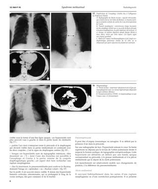 32-360-P-10 Syndrome médiastinal Radiodiagnostic 
visible sous la forme d’une fine ligne opaque ; ces hyperclartés sont 
plus souvent vues à gauche et dans la partie haute du médiastin 
(fig 17) ; 
– parfois l’air vient s’interposer entre le péricarde et le diaphragme 
qui devient visible dans sa partie médiastinale en continuité avec 
les deux coupoles ; c’est le signe du diaphragme continu (fig 18) ; 
– lorsque ces hyperclartés sont de topographie inférieure, elles 
dessinent un « V » dont l’une des branches est parallèle à 
l’oesophage et l’autre à la partie interne de la coupole 
diaphragmatique gauche ; cet aspect doit faire rechercher une 
rupture oesophagienne. 
– chez le nourrisson, le pneumomédiastin peut soulever le thymus, 
donnant l’image en « spinnaker » ou « thymus volant » (fig 19). 
Sur le profil, il est souvent mieux visible. Il donne des hyperclartés 
linéaires verticales, rétrosternales, qui se prolongent le long de la 
crosse aortique, des gros vaisseaux et de la trachée. 
15 Duplication de l’oesophage (clichés dus à l’obligeance 
du Professeur Diard). 
A. Radiographie du thorax de face : opacité rétrocardia-que 
à bord externe net (têtes de flèches). Le bouton aorti-que 
se projette à droite du rachis lié à une dextroposition 
de l’aorte. 
B. Transit oesophagien : volumineuse image lacunaire 
du bas oesophage (étoile) qui se raccorde de façon abrupte 
à la paroi oesophagienne, au pôle supérieur de la lésion. À 
ce niveau, la lumière digestive paraît élargie (flèche à 
deux têtes), étirée par cette masse. Cet aspect signe 
son origine pariétale. 
C. Masse de l’espace trachéooesophagien et de l’angle car-diophrénique 
postérieur (étoile) de 32 UH, ne se 
rehaussant pas après injection de produit de contraste. 
Pneumopéricarde 
Il peut être d’origine traumatique ou iatrogène. Il se définit par la 
présence d’air dans le péricarde. 
Sur une radiographie de face, l’hyperclarté entoure le coeur. Sa limite 
supérieure ne dépasse pas le niveau de l’artère pulmonaire droite et 
respecte le bouton aortique, de topographie extrapéricardique. Cette 
hyperclarté est délimitée en dehors par une bande opaque 
correspondant au péricarde, à la graisse médiastinale et à la plèvre 
médiastinale qui la sépare de la clarté pulmonaire. 
Cet épanchement est relativement mobile aux changements de 
position, à la différence du pneumomédiastin. 
Abcès médiastinal 
Il survient habituellement dans les suites d’une rupture 
oesophagienne ou d’une surinfection postopératoire. Il se présente 
*A 
*B 
*C 
16 Mégaoesophage. 
A. Thorax de face : important refoulement de la ligne pa-raoesophagienne 
avec un niveau hydroaérique dépassant 
la ligne médiane (flèches). 
B. Tomodensitométrie (TDM) : le mégaoesophage occupe 
l’espace sous- et rétrocarinaire. 
*A 
*B 
8 
 