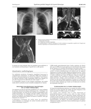 Radiodiagnostic Syndrome pariétal. Imagerie de la paroi thoracique 32-361-A-10 
*A 
2 Tumeur du sulcus pulmonis (têtes de flèche) avec syndrome de Pancoast et Tobias. 
A. Radiographie thoracique. 
B, C. Imagerie par résonance magnétique. 
D. Tomodensitométrie. L’étude de l’émergence de l’artère vertébrale est comparable en qualité entre l’imagerie par 
résonance magnétique et la tomodensitométrie avec reconstructions. 
La graisse est aussi présente dans les gouttières paravertébrales et 
aux sommets où elle participe à l’opacité de la coiffe apicale. 
Anatomie radiologique 
Les méthodes modernes d’imagerie simplifient beaucoup la 
compréhension anatomique, en particulier l’IRM pour laquelle le 
territoire ostéomusculaire est un terrain d’excellence. Nous situons 
les apports modernes (TDM, échographie, IRM) pour rappeler un 
peu plus longuement les difficultés du cliché simple [26, 58, 70]. 
La scintigraphie osseuse n’a pas d’apport anatomique. Son intérêt 
réside dans la recherche d’une éventuelle multiplicité de l’atteinte. 
IMAGERIE PAR RÉSONANCE MAGNÉTIQUE 
DE LA PAROI THORACIQUE 
Les séquences en écho de spin bien pondérées en T1, pour souligner 
les graisses, donnent des images anatomiques très « véridiques » de 
la paroi thoracique. Les côtes ont une corticale en hyposignal et une 
moelle hyperintense. Les cartilages sont bien visibles, et donc leurs 
fractures éventuelles. Les pondérations T2 ou les suppressions de 
graisse sont utilisées pour étudier les lésions et tumeurs, ainsi que 
l’injection de contraste [82, 83]. 
L’utilisation d’antennes de rachis pour les gouttières 
costovertébrales ou d’antennes de surface localisée permet une 
finesse anatomique avancée [28]. 
L’IRM étudie particulièrement bien l’orifice supérieur du thorax 
alors que la TDM est (un peu) gênée par le durcissement des rayons 
lié aux épaules et la moindre discrimination des parties molles [42, 49, 
82]. L’apex pulmonaire revêtu de ses plèvres monte plus haut en 
arrière. Le fascia endothoracique est renforcé par un appareil 
suspenseur. En arrière du dôme siègent les éléments nerveux : troncs 
inférieurs du plexus bronchial et ganglion stellaire avec son rapport 
à l’artère vertébrale par l’anse de Vieussens. Dans les tumeurs du 
sulcus pulmoni avec syndrome de Pancoast et Tobias, c’est cette 
région qu’il faut « imager » pour le chirurgien. En avant du dôme, 
la paroi est faite des scalènes postérieur et moyen, de l’artère puis 
de la veine sous-clavière plus antérieure et séparée de son artère par 
le muscle scalène antérieur qui s’insère sur le tubercule de Lisfranc 
de la première côte (fig 2). 
ÉCHOGRAPHIE DE LA PAROI THORACIQUE 
Si l’étude des épanchements pleuraux se contente de sondes simples, 
l’étude de la paroi nécessite des sondes de haute fréquence et de 
haute résolution (7,5 MHz et plus, 10, 12 MHz). 
Les coupes sont réalisées dans le plan intercostal et 
perpendiculairememnt à celui-ci avec, alors, les cônes d’ombre 
successifs des côtes. Avant la diffraction aérique pulmonaire qui 
constitue le plan profond, on essaye de dissocier les plans pleuraux 
et extrapleuraux. Le plan pleural est constitué d’une ligne fortement 
hyperéchogène. En dehors, une bande faiblement échogène, 
d’épaisseur variable, représente le fascia endothoracique et la graisse 
extrapleurale (fig 3). 
*B 
*C 
*D 
3 
 