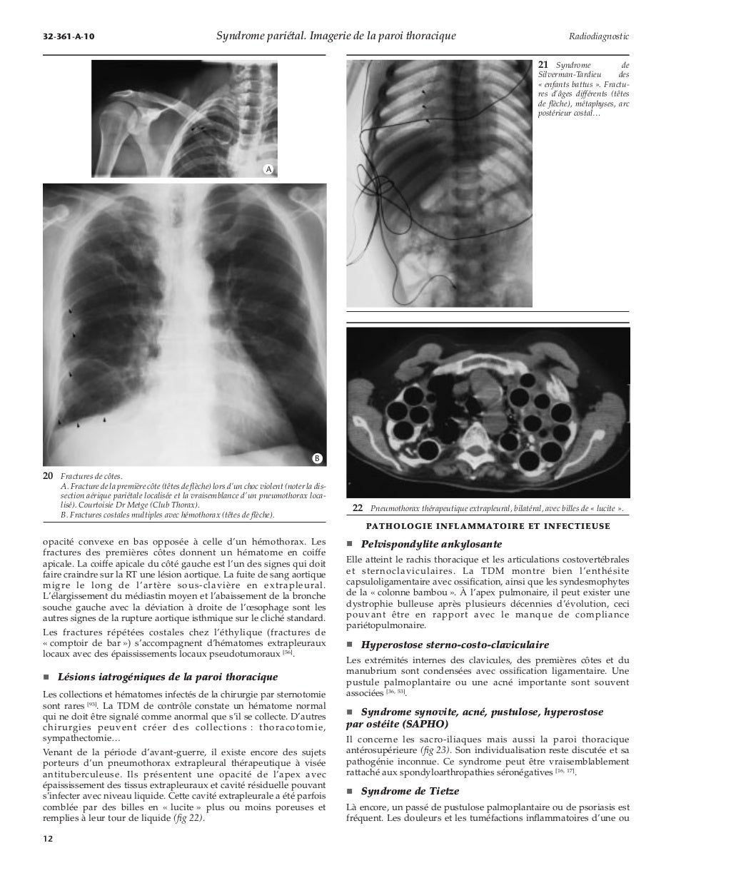 Syndrome pariétal imagerie de la paroi thoracique