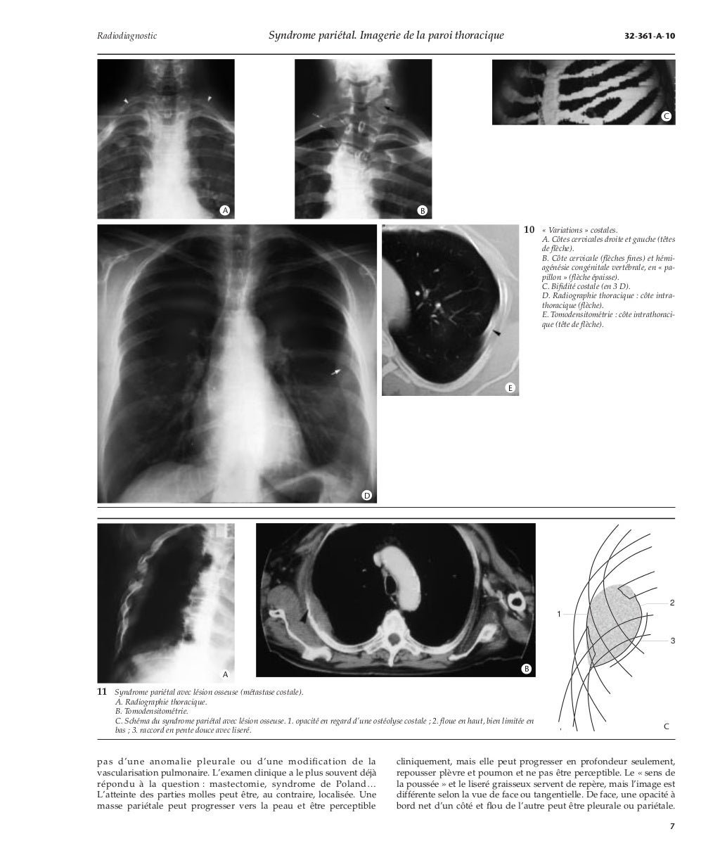 Syndrome pariétal imagerie de la paroi thoracique