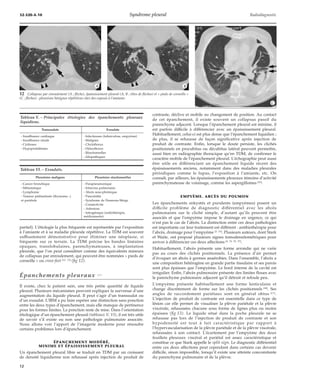 32-520-A-10 Syndrome pleural Radiodiagnostic 
*A *B 
12 Collapsus par enroulement (A ; flèche), épaississement pleural (A, B ; têtes de flèches) et « pieds de corneille » 
(C ; flèches) : pleurésies bénignes répétitives chez des exposés à l’amiante. 
partiel). L’étiologie la plus fréquente est représentée par l’exposition 
à l’amiante et à sa maladie pleurale répétitive. La TDM est souvent 
suffisamment démonstrative pour éliminer une néoplasie, si 
fréquente sur ce terrain. La TDM précise les bandes linéaires 
opaques, translobulaires, parenchymateuses, à implantation 
pleurale, que l’on peut considérer comme des équivalents mineurs 
de collapsus par enroulement, qui peuvent être nommées « pieds de 
corneille » ou crow-feet [12, 13] (fig 12). 
Épanchements pleuraux [27] 
Il existe, chez le patient sain, une très petite quantité de liquide 
pleural. Plusieurs mécanismes peuvent expliquer la survenue d’une 
augmentation du liquide pleural. Il peut s’agir d’un transsudat ou 
d’un exsudat. L’IRM a pu faire espérer une distinction sans ponction 
entre les deux types d’épanchement, mais elle manque de pertinence 
pour les formes limites. La ponction reste de mise. Dans l’orientation 
étiologique d’un épanchement pleural (tableaux V, VI), il est très utile 
de savoir s’il existe ou non une pathologie pulmonaire associée. 
Nous allons voir l’apport de l’imagerie moderne pour résoudre 
certains problèmes lors d’épanchement. 
ÉPANCHEMENT MODÉRÉ, 
MINIME ET ÉPAISSISSEMENT PLEURAL 
Un épanchement pleural libre se traduit en TDM par un croissant 
de densité liquidienne non rehaussé après injection de produit de 
*C 
contraste, déclive et mobile au changement de position. Au contact 
de cet épanchement, il existe souvent un collapsus passif du 
parenchyme adjacent. Lorsque l’épanchement pleural est minime, il 
est parfois difficile à différencier avec un épaississement pleural. 
Habituellement, celui-ci est plus dense que l’épanchement liquidien ; 
de plus, il se rehausse de façon significative après injection de 
produit de contraste. Enfin, lorsque le doute persiste, les clichés 
positionnels en procubitus ou décubitus latéral peuvent permettre, 
aussi bien en radiographie thoracique qu’en TDM, de confirmer le 
caractère mobile de l’épanchement pleural. L’échographie peut aussi 
être utile en différenciant un épanchement liquide récent des 
épaississements anciens, notamment dans des maladies pleurales 
périodiques comme le lupus, l’exposition à l’amiante, etc. On 
connaît, par ailleurs, les épaississements pleuraux témoins d’activité 
parenchymateuse de voisinage, comme les aspergillomes [29]. 
EMPYÈME. ABCÈS DU POUMON 
Les épanchements enkystés et purulents (empyèmes) posent un 
difficile problème de diagnostic différentiel avec les abcès 
pulmonaires sur le cliché simple, d’autant qu’ils peuvent être 
associés et que l’empyème impose le drainage en urgence, ce qui 
n’est pas le cas de l’abcès. La distinction entre ces deux pathologies 
est importante car leur traitement est différent : antibiothérapie pour 
l’abcès, drainage pour l’empyème [3, 23]. Plusieurs auteurs, dont Stark 
et Waite, ont proposé plusieurs signes tomodensitométriques pour 
arriver à différencier ces deux affections [4, 53, 55, 57]. 
Habituellement, l’abcès présente une forme arrondie qui ne varie 
pas au cours des clichés positionnels. La présence d’air permet 
d’évoquer un abcès à germes anaérobies. Dans l’ensemble, l’abcès a 
une composition hétérogène en grande partie tissulaire et ses parois 
sont plus épaisses que l’empyème. Le bord interne de la cavité est 
irrégulier. Enfin, l’abcès pulmonaire présente des limites floues avec 
le parenchyme pulmonaire adjacent qu’il détruit et refoule peu. 
L’empyème présente habituellement une forme lenticulaire et 
change discrètement de forme sur les clichés positionnels [28]. Ses 
angles de raccordement pariétaux sont en général obtus [21]. 
L’injection de produit de contraste est essentielle dans ce type de 
lésion car elle permet de visualiser la plèvre pariétale et la plèvre 
viscérale, rehaussées chacune sous forme de lignes plus ou moins 
épaisses (fig 13). Le liquide situé dans la poche pleurale ne se 
rehausse pas lors de l’injection de produit de contraste et son 
hypodensité est tout à fait caractéristique par rapport à 
l’hypervascularisation de la plèvre pariétale et de la plèvre viscérale, 
rehaussées à son contact. L’écartement par l’empyème des deux 
feuillets pleuraux viscéral et pariétal est assez caractéristique et 
constitue ce que Stark appelle le split sign. Le diagnostic différentiel 
entre ces deux affections peut cependant dans certains cas devenir 
difficile, sinon impossible, lorsqu’il existe une atteinte concomitante 
du parenchyme pulmonaire et de la plèvre. 
Tableau V. – Principales étiologies des épanchements pleuraux 
liquidiens. 
Transsudats Exsudats 
- Insuffisance cardiaque - Infectieuses (tuberculose, empyème) 
- Insuffisance rénale - Malignes 
- Cirrhoses - Chylothorax 
- Hypoprotidémies - Hémothorax 
- Réactionnelles 
- Idiopathiques 
Tableau VI. – Exsudats. 
Pleurésies malignes Pleurésies réactionnelles 
- Cancer bronchique - Parapneumonique 
- Métastatique - Infarctus pulmonaire 
- Lymphome - Abcès sous-phrénique 
- Tumeur pédiastinale (thymome...) - Pancréatite 
et pariétale - Syndrome de Desmons-Meigs 
- Connectivite 
- Asbestose 
- Iatrogénique (radiothérapie, 
médicaments) 
12 
 