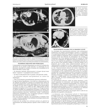 Radiodiagnostic Syndrome pleural 32-520-A-10 
PLEURÉSIE ENKYSTÉE NON PURULENTE 
*A 
*B 
L’enkystement se rencontre fréquemment au cours de l’évolution des 
pleurésies de la grande cavité pleurale. La sémiologie de ces 
pleurésies enkystées est variable en fonction de la localisation de la 
lésion elle-même. Il peut s’agir : 
– de pleurésie enkystée interscissuraire à évoquer devant toute 
lésion « expansive » se projetant sur les scissures ; 
– de lésion d’enkystement dans la grande cavité pleurale costale ; 
– de pleurésie enkystée sous-pulmonaire au contact du 
diaphragme ; 
– enfin, de localisation paramédiastinale (pleurésie médiastine). 
Il s’agit de lésions liquidiennes, c’est-à-dire ne se rehaussant pas lors 
de l’injection de produit de contraste et de densité basse autour de 
0 unité Hounsfield (UH), parfois légèrement élevée selon la nature 
du liquide (10 UH). Dans ce domaine, l’IRM est d’un grand apport 
s’il existe un doute sur la TDM. En effet, l’IRM permet de bien 
distinguer les liquides en T2 et aussi le sang en T1. Il s’agit de lésions 
en général sensibles aux changements de position. Ces lésions sont 
souvent associées à des lésions pleuroparenchymateuses séquellaires 
(épaississements pleuraux, atélectasie ronde, cicatrisation 
pulmonaire périphérique avec invagination pleurale et bandes 
parenchymateuses en « pieds de corneille »). 
Pour une pleurésie enkystée, non ponctionnée, la présence d’air 
évoque l’existence possible d’une fistulation bronchique (fistule entre 
poumon et plèvre) (fig 14). 
L’injection de produit de contraste permet en général le 
rehaussement des feuillets pleuraux épaissis créant le fameux split 
sign. 
ÉPANCHEMENT PLEURAL DE LA GRANDE CAVITÉ 
Les étiologies des épanchements pleuraux sont extrêmement 
nombreuses. En pratique pneumologique courante, la constatation 
d’un épanchement pleural de la grande cavité pose le problème de 
sa nature maligne ou infectieuse. Dans ce domaine, la TDM et l’IRM 
peuvent amener des éléments de présomption. Par exemple, la 
constatation, lors d’une injection de produit de contraste en TDM 
ou lors de la réalisation de différentes séquences pondérées en T1, 
T2 et T1 avec injection de gadolinium, de nodulations pleurales est 
très en faveur d’une pleurésie maligne. Il faut bien insister sur la 
disparité qu’il existe entre l’épaississement pleural et 
l’épaississement extrapleural. En effet, l’augmentation de la graisse 
extrapleurale se rencontre au cours des pleurésies chroniques. Dans 
ce cas, l’épaississement pleural est moins important que 
l’épaississement graisseux extrapleural. Une pleurésie qui 
s’accompagne d’une augmentation importante de la graisse 
extrapleurale, d’un épaississement modéré et parcellaire des feuillets 
pleuraux, de calcifications pleurales, évoque plutôt un processus 
infectieux chronique, y compris la tuberculose. On peut constater le 
signe de la « double bande » dû à la visualisation, en dehors de la 
plèvre pariétale, du fascia endothoracique attiré dans la cavité 
thoracique (fig 15). 
Les épanchements pleuraux, même de petite abondance, qu’ils 
soient suspendus ou cloisonnés, sont aisément repérables en 
échographie et donc facilement ponctionnables. De ce fait, la TDM 
est rarement utilisée pour la réalisation de la ponction d’un 
épanchement pleural liquide. La TDM, en revanche, est utile pour la 
surveillance des drainages pleuraux en confirmant ou en infirmant 
la position de l’extrémité du drain dans la cavité pleurale. 
Quelques problèmes particuliers sont évoqués dans le cadre de ces 
pleurésies de la grande cavité pleurale : 
– la distinction entre l’épanchement pleural et l’épanchement 
péritonéal (tableau VII) : les coupoles diaphragmatiques sont visibles 
en TDM lorsqu’elles sont limitées en dedans par la graisse 
péritonéale ou une éventuelle stéatose hépatique et en dehors par 
l’air pulmonaire ; le repérage de ces coupoles diaphragmatiques est 
important lorsqu’il s’agit de distinguer un épanchement pleural de 
petite abondance d’un épanchement péritonéal ; habituellement, un 
épanchement pleural est de topographie périphérique en dehors de 
13 Fistule bronchopleurale sur empyème : sujet alcoolotabagique fébrile avec abcès 
pulmonaire (A, têtes de flèches) associé à un empyème (B, tête de flèche) et compliqué, 
du fait d’un traumatisme (chute en état d’ivresse), d’un pneumomédiastin et d’un em-physème 
sous-cutané. Position en procubitus pour drainage sous tomodensitométrie. 
14 Fistule bronchopleu-rale 
sous empyème : poche 
pleurale d’origine tubercu-leuse, 
surinfectée et réacti-vée 
avec dissémination 
bronchogène homolatérale 
via la fistule bronchopleu-rale. 
15 Signe de la « double bande ». Après 
pleurésie infectieuse chronique (surtout 
tuberculeuse), le fascia endothoracique 
(B-A) et la graisse extrapleurale sont atti-rés 
à l’intérieur, et la plèvre pariétale est 
épaissie (D-C) et très interne, elle aussi. 
13 
 