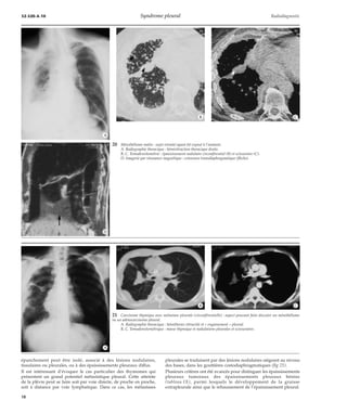 32-520-A-10 Syndrome pleural Radiodiagnostic 
20 Mésothéliome malin : sujet retraité ayant été exposé à l’amiante. 
A. Radiographie thoracique : hémirétraction thoracique droite. 
B, C. Tomodensitométrie : épaississement nodulaire circonférentiel (B) et scissuraire (C). 
D. Imagerie par résonance magnétique : extension transdiaphragmatique (flèche). 
épanchement peut être isolé, associé à des lésions nodulaires, 
tissulaires ou pleurales, ou à des épaississements pleuraux diffus. 
Il est intéressant d’évoquer le cas particulier des thymomes qui 
présentent un grand potentiel métastatique pleural. Cette atteinte 
de la plèvre peut se faire soit par voie directe, de proche en proche, 
soit à distance par voie lymphatique. Dans ce cas, les métastases 
pleurales se traduisent par des lésions nodulaires siégeant au niveau 
des bases, dans les gouttières costodiaphragmatiques (fig 21). 
Plusieurs critères ont été avancés pour distinguer les épaississements 
pleuraux tumoraux des épaississements pleuraux bénins 
(tableau IX), parmi lesquels le développement de la graisse 
extrapleurale ainsi que le rehaussement de l’épaississement pleural. 
*A 
*B *C 
*D 
21 Carcinome thymique avec métastase pleurale (circonférentielle) : aspect pouvant faire discuter un mésothéliome 
ou un adénocarcinome pleural. 
A. Radiographie thoracique : hémithorax rétractile et « engainement » pleural. 
B, C. Tomodensitométrique : masse thymique et nodulations pleurales et scissuraires. 
*A 
*B *C 
18 
 