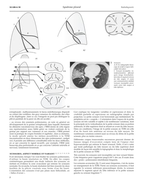 32-520-A-10 Syndrome pleural Radiodiagnostic 
1 
2 
1 
extrapleurale ; malheureusement, le fascia endothoracique disparaît 
au contact des vertèbres, des gros vaisseaux du médiastin, des côtes 
et du diaphragme ; dans ce cas, l’imagerie ne peut pas distinguer la 
plèvre pariétale de la paroi où elle est accolée ; 
– au niveau des sommets pulmonaires, on note en général un 
développement de la graisse extrapleurale dans laquelle cheminent 
les éléments vasculonerveux des apex ; l’IRM donne de cette région 
une représentation assez fidèle grâce au violent contraste de la 
graisse par rapport aux vaisseaux et aux muscles ; l’IRM permet 
aussi la pratique de coupes frontales et sagittales ; dans ce domaine, 
le mode spiralé amène les mêmes possibilités à la TDM 
(reconstruction en deux dimensions des apex pulmonaires) ; malgré 
ceci, il persiste une différence considérable entre les deux méthodes, 
en ce qui concerne le signal recueilli ; par exemple, l’IRM reste 
beaucoup plus performante en ce qui concerne l’atteinte artérielle et 
nerveuse, notamment foraminale. 
SCISSURES, ASPECT NORMAL ET VARIANT [11, 15, 16, 17, 18, 19, 43] 
Il est nécessaire, lorsque l’on veut étudier les scissures pulmonaires, 
d’utiliser la haute résolution en TDM. En effet, les coupes 
centimétriques permettent une étude indirecte des scissures, en 
mettant en évidence la zone avasculaire qui entoure les scissures 
normales. En revanche, la haute résolution fait bien ressortir les deux 
feuillets de la plèvre viscérale sous forme d’un fin liseré. 
L’orientation des scissures n’est pas plane mais hélicoïdale, en 
« hélice d’avion ». 
Ceci explique les tangentes variables et capricieuses et donc la 
visibilité partielle et capricieuse en radiographie simple par 
projection. La petite scissure n’est horizontale que médialement. Sa 
périphérie est en « coupole ». L’orientation dans l’espace de la petite 
scissure est très variable et sujette à de nombreuses variations, dont 
la principale est la verticalisation de la petite scissure dans sa portion 
antérieure, le lobe supérieur droit se situant en avant du lobe moyen. 
Dans ces conditions, l’image de la petite scissure en TDM est celle 
d’un fin liseré très antérieur au niveau du lobe moyen. De 
nombreuses variations existent aussi au niveau du dôme de la petite 
scissure, plus ou moins concave. 
Différentes coupes transversales successives peuvent donner de 
fausses images d’excavation compte tenu de l’espace clair 
hypovascularisé qui entoure le liseré scissural. Enfin, il est à noter 
que toute pathologie du lobe moyen ou du lobe supérieur droit 
modifie de façon très sensible la topographie et donc la morphologie 
de la petite scissure en TDM. 
Très souvent, les scissures sont incomplètes sur leur versant hilaire. 
Cette fréquence peut s’apprécier jusqu’à 60 % des cas. Il existe donc 
des « ponts » pulmonaires interlobaires fréquents. 
Les scissures accessoires (fig 3) sont assez fréquentes, c’est du moins 
un enseignement de la TDM. Parmi ces scissures accessoires, il faut 
signaler la scissure inférieure paracardiaque droite, la scissure 
séparant le segment apical du lobe inférieur et la petite scissure 
gauche ou scissure lingulaire [2]. 
2 
3 
1 
1 
2 
s5 
s8 
s6 
s10 
s5 
s8 
s6 
s10 
3 
1 3 
3 
3 
1 3 
5 h 
7 h 5 h 
9 h 3 h 
11 h 1 h 
2 
2 Scissures. 
A, B. En radiographie thora-cique 
de profil et aspect héli-coïdal 
(non plan). 
C. Scissure incomplète : to-modensitométrie 
effectuée 
après lavage bronchoalvéo-laire 
dans le segment externe 
du lobe moyen. Il existe 
une communication médiale 
(scissure incomplète proxi-male) 
entre lobe moyen et 
lobe inférieur. 
"A1 
"A2 
" 
" 
*C 
"B1 
"B2 
2 
 