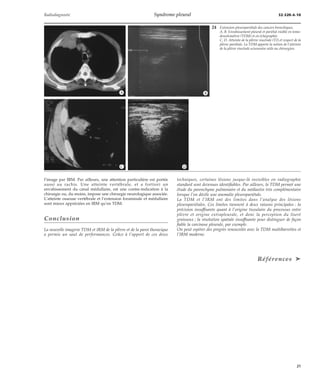 Radiodiagnostic Syndrome pleural 32-520-A-10 
l’image par IRM. Par ailleurs, une attention particulière est portée 
aussi au rachis. Une atteinte vertébrale, et a fortiori un 
envahissement du canal médullaire, est une contre-indication à la 
chirurgie ou, du moins, impose une chirurgie neurologique associée. 
L’atteinte osseuse vertébrale et l’extension foraminale et médullaire 
sont mieux appréciées en IRM qu’en TDM. 
Conclusion 
La nouvelle imagerie TDM et IRM de la plèvre et de la paroi thoracique 
a permis un saut de performances. Grâce à l’apport de ces deux 
24 Extension pleuropariétale des cancers bronchiques. 
A, B. Envahissement pleural et pariétal visible en tomo-densitométrie 
(TDM) et en échographie. 
C, D. Atteinte de la plèvre viscérale (T2) et respect de la 
plèvre pariétale. La TDM apporte la notion de l’atteinte 
de la plèvre viscérale scissuraire utile au chirurgien. 
techniques, certaines lésions jusque-là invisibles en radiographie 
standard sont devenues identifiables. Par ailleurs, la TDM permet une 
étude du parenchyme pulmonaire et du médiastin très complémentaire 
lorsque l’on décèle une anomalie pleuropariétale. 
La TDM et l’IRM ont des limites dans l’analyse des lésions 
pleuropariétales. Ces limites tiennent à deux raisons principales : la 
précision insuffisante quant à l’origine tissulaire du processus entre 
plèvre et origine extrapleurale, et donc la perception du liseré 
graisseux ; la résolution spatiale insuffisante pour distinguer de façon 
fiable la carcinose pleurale, par exemple. 
On peut espérer des progrès renouvelés avec la TDM multibarrettes et 
l’IRM moderne. 
Références ä 
*A *B 
*C *D 
21 
 