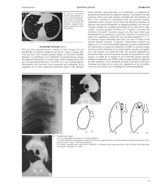 Radiodiagnostic Syndrome pleural 32-520-A-10 
SCISSURE AZYGOS (fig 4) 
Elle est une pseudoscissure comme le lobe azygos est un 
pseudolobe. La scissure azygos est en fait un « méso » azygos. Elle 
n’est pas une vraie scissure puisque quatre, et non deux feuillets 
pleuraux, la constituent. Ceci rapproche la pseudoscissure azygos 
du ligament pulmonaire. La veine azygos reste extrapleurale et non 
pas intraparenchymateuse. Présente sur des radiographies 
thoraciques, elle provient d’une anomalie mal expliquée de la 
migration de la veine cardinale postérieure droite. Cette dernière 
laisse subsister, entre son méso et le médiastin, un fragment de 
parenchyme pulmonaire du segment antérieur et postérieur du lobe 
supérieur droit, mais reste toujours extrapleurale. En incidence de 
face, cette variante est caractérisée par une opacité linéaire 
supérieure droite, concave vers le haut et le dedans et terminée en 
haut par une opacité triangulaire, le trigonum pariétal, et en bas par 
l’opacité ovalaire de la portion horizontale de la crosse de la veine 
azygos. L’aspect général est donc en « virgule » inversée. En 
incidence de profil, l’opacité azygos est plus haut située que 
normalement et le poumon, en pouvant s’insinuer en arrière de la 
veine cave supérieure, permet de voir son bord postérieur [35, 51, 54]. 
La scissure azygos elle-même peut être vue sous la forme d’une 
opacité linéaire verticale. À gauche, l’observation similaire en 
rapport avec la veine intercostale supérieure est très exceptionnelle 
et, si nécessaire, sa nature est confirmée en TDM. La scissure azygos 
ne doit pas être confondue avec d’autres lignes apicales, en rapport 
avec une cicatrice, une paroi de bulle, des scissures déplacées ou 
accessoires. Dans ces cas, la position normale de l’opacité de la veine 
azygos, à l’angle de la trachée et de la bronche souche gauche, 
redresse le diagnostic. En TDM, le lobe azygos modifie les rapports 
du lobe supérieur et du médiastin puisque le poumon droit peut 
s’insinuer en arrière de la veine cave supérieure et de la trachée, 
voire avec un contact avec l’oesophage et l’aorte descendante. 
3 Scissures accessoires. 
Scissure paracardiaque en-tre 
S7 et S8 (tête de flèche) ; 
scissure dans le lobe moyen 
entre S4 et S5 (double tête 
de flèche) ; ligament trian-gulaire 
pulmonaire (triple 
tête de flèche). 
A 
B C 
*A 
4 Pseudoscissure azygos. 
A, B. En radiographie thoracique et en tomodensitométrie. 
C. Schéma expliquant la topographie extrapleurale de la veine azygos aberrante, la présence de quatre replis pleuraux et donc le faux 
nom de scissure (« méso » serait plus approprié). 
D. Curiosité : pseudoscissure azygos droite « habituelle » et pseudoscissure azygos gauche par veine de Braine intercostale supé-rieure 
gauche suspendue en « méso ». 
*B 
"C1 "C2 
*D 
3 
 