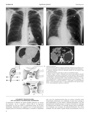 32-520-A-10 Syndrome pleural Radiodiagnostic 
LIGAMENT TRIANGULAIRE 
*C *D 
(OU LIGAMENT PULMONAIRE INFÉRIEUR) 
*A *B 
Il représente la réflexion de quatre feuillets pleuraux au niveau 
du« manche » de la « raquette » hilaire (fig 5). Le ligament 
triangulaire ne fait pas partie à proprement parler de la paroi 
thoracique. Néanmoins, ses rapports avec la cavité pleurale le 
rangent parmi les structures anatomiques à connaître. Il représente 
5 Ligament pulmonaire. 
A, B. Pneumothorax (flèches) et ligament pulmonaire silhouetté (grosse flèche) en ins-piration 
et en expiration, et pneumothorax de la plèvre médiastine (têtes de flèches). 
C. Ligament pulmonaire droit avec atélectasie partielle du lobe inférieur droit 
et épanchement massif. 
D. Ligament pulmonaire gauche dans le cadre d’un mésothéliome évolué. 
E. Schéma : l’espace « virtuel » médiastinal situé entre les deux réflexions pleurales 
(viscérale-pariétale) antérieures et postérieures est bien démontré. Dans cet espace 
« communiquant » passent des lymphatiques et des vaisseaux comme d’éventuelles ar-tères 
bronchiques surnuméraires dites « artères bronchiques du ligament ». 1. Liga-ment 
triangulaire droit ; 2. ligament triangulaire gauche ; 3. aorte ; 4. oesophage ; 5. li-gament 
de Morozow ; 6. veine cave inférieure ; 7. veine azygos ; 8. bronche supérieure 
droite ; 9. artère pulmonaire droite ; 9’. artère médiastinale et lobe supérieur droit ; 
10-10’. veines pulmonaires supérieure et inférieure. 
une voie de communication plus ou moins virtuelle entre 
l’interstitium pulmonaire et le médiastin. Il peut livrer passage à 
des lymphatiques et à des artères à destinée bronchique. Lors des 
hyperpressions intrathoraciques, la rupture d’alvéoles au voisinage 
du ligament peut aboutir à un passage aérique dans le médiastin. 
Ceci explique, par exemple, les pneumomédiastins des crises 
d’asthme, lors des efforts à glotte fermée (accouchement, drive au 
*E 
4 
 