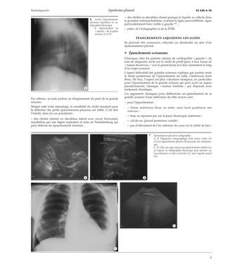 Radiodiagnostic Syndrome pleural 32-520-A-10 
Par ailleurs, on note parfois un élargissement du pied de la grande 
scissure. 
Malgré cette riche sémiologie, la sensibilité du cliché standard pour 
la détection des petits épanchements pleuraux est faible. C’est dire 
l’intérêt, dans les cas précédents : 
– des clichés réalisés en décubitus latéral avec rayon horizontal, 
sensibilisés par une légère expiration et mise en Trendelenburg qui 
peut détecter les épanchements minimes ; 
– des clichés en décubitus dorsal puisque le liquide se collecte dans 
la gouttière latérorachidienne, écartant la ligne paravertébrale, signe 
particulièrement bien visible à gauche [47] ; 
– enfin, de l’échographie et de la TDM. 
ÉPANCHEMENTS LIQUIDIENS LOCALISÉS 
Ils peuvent être scissuraux, enkystés ou dissimulés au sein d’un 
épaississement pleural. 
¦ Épanchements scissuraux 
Classiques chez les patients atteints de cardiopathie « gauche », ils 
sont de diagnostic facile sur le cliché de profil grâce à leur forme en 
« fuseau biconvexe » vers le parenchyme et à leur orientation le long 
d’un trajet scissural. 
L’aspect hélicoïdal des grandes scissures explique que parfois seule 
la limite postérieure de l’épanchement est nette, l’antérieure étant 
floue. De face, l’aspect est plus volontiers trompeur, en particulier 
pour l’épanchement de la grande scissure qui peut avoir un aspect 
pseudotumoral, classique « tumeur fantôme » qui disparaît sous 
traitement diurétique. 
Les arguments classiques pour différencier un épanchement de la 
grande scissure d’une atélectasie du lobe moyen sont : 
– pour l’épanchement : 
– limite antérieure floue ou nette, mais bord postérieur net 
convexe ; 
– base ne reposant pas sur la paroi thoracique antérieure ; 
– cul-de-sac pleural postérieur comblé ; 
– pas d’effacement de l’arc inférieur du coeur sur le cliché de face ; 
6 (suite) Épanchements 
pleuraux liquidiens en ra-diographie 
thoracique. 
E. Épanchement en 
« navette » de la petite 
scissure (F et P). 
*E 
7 Épanchement pleural et échographie. 
A, B. Diagnostic échographique d’un cancer rénal (A) 
et d’un épanchement pleural (B) pouvant être métastati-que. 
C, D. Chez un sujet exposé aux épanchements répétés (ici 
un lupus), la radiographie thoracique peut montrer un 
raccordement en fait cicatriciel (C) sans liquide actuel 
(D). 
*A *B 
*C 
*D 
7 
 