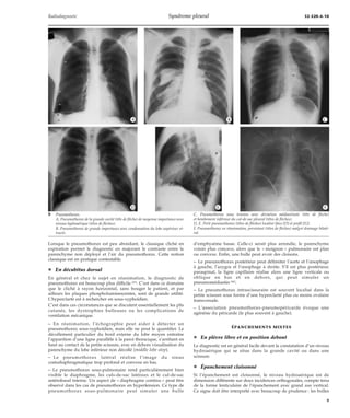 Radiodiagnostic Syndrome pleural 32-520-A-10 
*A *B *C 
*D *E *F 
Lorsque le pneumothorax est peu abondant, le classique cliché en 
expiration permet le diagnostic en majorant le contraste entre le 
parenchyme non déployé et l’air du pneumothorax. Cette notion 
classique est en pratique contestable. 
¦ En décubitus dorsal 
En général et chez le sujet en réanimation, le diagnostic de 
pneumothorax est beaucoup plus difficile [47]. C’est dans ce domaine 
que le cliché à rayon horizontal, sans bouger le patient, et par 
ailleurs les plaques phospholuminescentes, sont de grande utilité. 
L’hyperclarté est à rechercher en sous-xyphoïdien. 
C’est dans ces circonstances que se discutent essentiellement les plis 
cutanés, les dystrophies bulleuses ou les complications de 
ventilation mécanique. 
– En réanimation, l’échographie peut aider à détecter un 
pneumothorax sous-xyphoïdien, mais elle ne peut le quantifier. Le 
décollement particulier du bord externe du lobe moyen entraîne 
l’apparition d’une ligne parallèle à la paroi thoracique, s’arrêtant en 
haut au contact de la petite scissure, avec en dehors visualisation du 
parenchyme du lobe inférieur non décollé (middle lobe step). 
– Le pneumothorax latéral réalise l’image du sinus 
costodiaphragmatique trop profond et convexe en bas. 
– Le pneumothorax sous-pulmonaire rend particulièrement bien 
visible le diaphragme, les culs-de-sac latéraux et le cul-de-sac 
antérobasal interne. Un aspect de « diaphragme continu » peut être 
observé dans les cas de pneumothorax en hypertension. Ce type de 
pneumothorax sous-pulmonaire peut simuler une bulle 
d’emphysème basse. Celle-ci serait plus arrondie, le parenchyme 
voisin plus concave, alors que le « moignon » pulmonaire est plan 
ou convexe. Enfin, une bulle peut avoir des cloisons. 
– Le pneumothorax postérieur peut délimiter l’aorte et l’oesophage 
à gauche, l’azygos et l’oesophage à droite. S’il est plus postérieur, 
paraspinal, la ligne capillaire réalise alors une ligne verticale ou 
oblique en bas et en dehors, qui peut simuler un 
pneumomédiastin [46]. 
– Le pneumothorax intrascissuraire est souvent localisé dans la 
petite scissure sous forme d’une hyperclarté plus ou moins ovalaire 
transversale. 
– L’association pneumothorax-pneumopéricarde évoque une 
agénésie du péricarde (le plus souvent à gauche). 
ÉPANCHEMENTS MIXTES 
¦ En plèvre libre et en position debout 
Le diagnostic est en général facile devant la constatation d’un niveau 
hydroaérique qui se situe dans la grande cavité ou dans une 
scissure. 
¦ Épanchement cloisonné 
Si l’épanchement est cloisonné, le niveau hydroaérique est de 
dimension différente sur deux incidences orthogonales, compte tenu 
de la forme lenticulaire de l’épanchement avec grand axe vertical. 
Ce signe doit être interprété avec beaucoup de prudence : les bulles 
8 Pneumothorax. 
A. Pneumothorax de la grande cavité (tête de flèche) de moyenne importance avec 
niveau hydroaérique (têtes de flèches). 
B. Pneumothorax de grande importance avec condensation du lobe supérieur ré-tracté. 
C. Pneumothorax sous tension avec déviation médiastinale (tête de flèche) 
et bombement inférieur du cul-de-sac pleural (têtes de flèches). 
D, E. Petit pneumothorax (têtes de flèches) localisé (face [D] et profil [E]). 
F. Pneumothorax en réanimation, persistant (têtes de flèches) malgré drainage bilaté-ral. 
9 
 