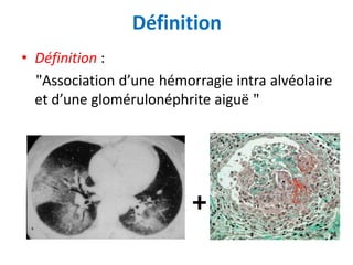 Définition
• Définition :
"Association d’une hémorragie intra alvéolaire
et d’une glomérulonéphrite aiguë "
+
 