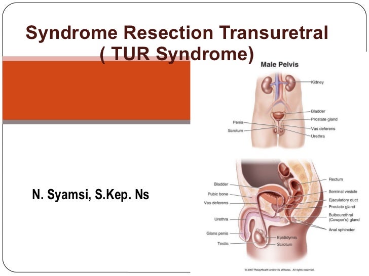 Syndrome Resection Transuretral Tur Syndrom