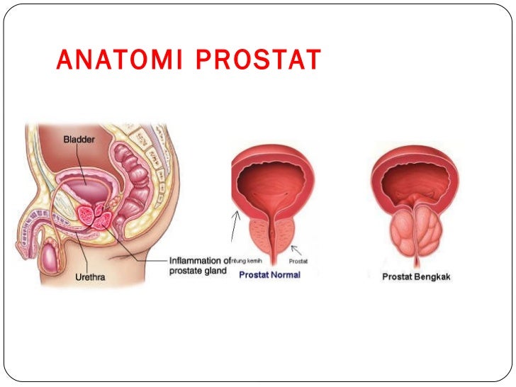 Syndrome Resection Transuretral Tur Syndrom