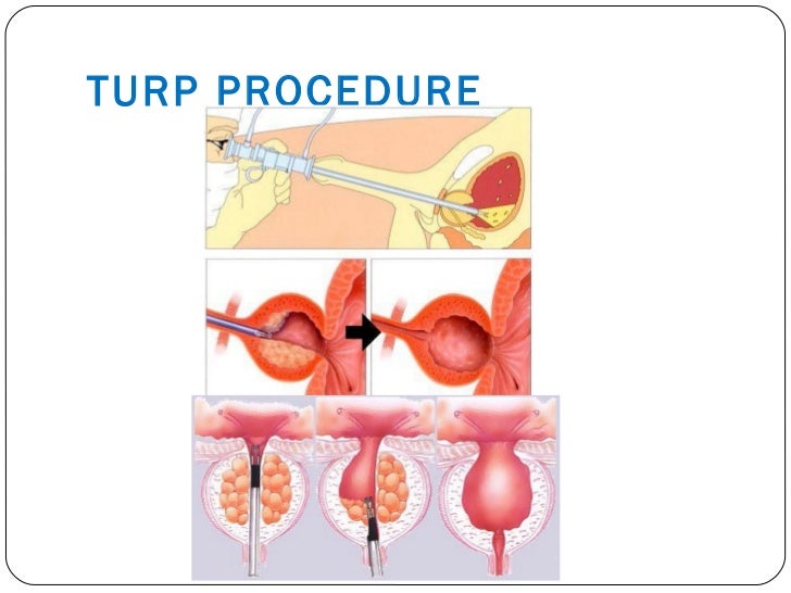 Syndrome Resection Transuretral Tur Syndrom