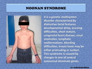 NOONAN SYNDROME
It is a genetic multisystem
disorder characterised by
distinctive facial features,
developmental delay, learning
difficulties, short stature,
congenital heart disease, renal
anomalies, lymphatic
malformations, bleeding
difficulties, breast bone may be
either protruding or sunken.
This syndrome is caused by
changes in one of several
autosomal dominant genes.
By MaleehaFatima
 