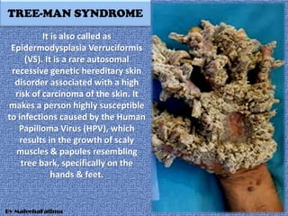 TREE-MAN SYNDROME
It is also called as
Epidermodysplasia Verruciformis
(VS). It is a rare autosomal
recessive genetic hereditary skin
disorder associated with a high
risk of carcinoma of the skin. It
makes a person highly susceptible
to infections caused by the Human
Papilloma Virus (HPV), which
results in the growth of scaly
muscles & papules resembling
tree bark, specifically on the
hands & feet.
By MaleehaFatima
 