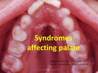 Syndromes
affecting palate
www.indiandentalacademy.com
INDIAN DENTAL ACADEMY
Leader in continuing Dental Education
 
