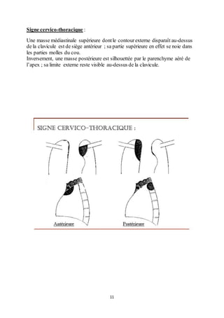 11
Signe cervico-thoracique :
Une masse médiastinale supérieure dontle contourexterne disparaît au-dessus
de la clavicule est de siège antérieur ; sa partie supérieure en effet se noie dans
les parties molles du cou.
Inversement, une masse postérieure est silhouettée par le parenchyme aéré de
l’apex ; sa limite externe reste visible au-dessus de la clavicule.
 
