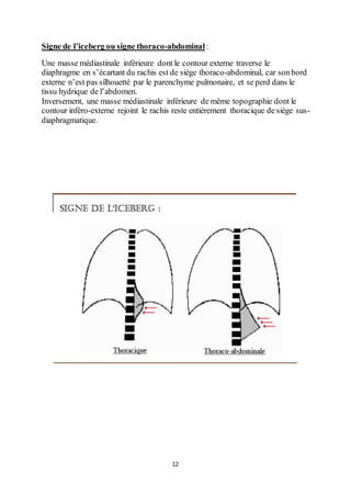 12
Signe de l’iceberg ou signe thoraco-abdominal :
Une masse médiastinale inférieure dont le contour externe traverse le
diaphragme en s’écartant du rachis est de siège thoraco-abdominal, car sonbord
externe n’est pas silhouetté par le parenchyme pulmonaire, et se perd dans le
tissu hydrique de l’abdomen.
Inversement, une masse médiastinale inférieure de même topographie dont le
contour inféro-externe rejoint le rachis reste entièrement thoracique de siège sus-
diaphragmatique.
 
