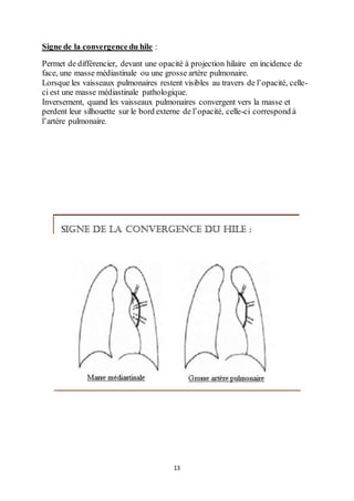 13
Signe de la convergence du hile :
Permet de différencier, devant une opacité à projection hilaire en incidence de
face, une masse médiastinale ou une grosse artère pulmonaire.
Lorsque les vaisseaux pulmonaires restent visibles au travers de l’opacité, celle-
ci est une masse médiastinale pathologique.
Inversement, quand les vaisseaux pulmonaires convergent vers la masse et
perdent leur silhouette sur le bord externe de l’opacité, celle-ci correspond à
l’artère pulmonaire.
 