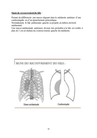 14
Signe de recouvrementdu hile :
Permet de différencier une masse siégeant dans le médiastin antérieur d’une
cardiomégalie ou d’un épanchement péricardique.
Normalement, le hile pulmonaire gauche se projette en dehors du bord
médiastinal.
Une masse médiastinale antérieure devient très probable si le hile est visible à
plus de 1 cm en dedans du contourexterne gauche du médiastin.
 