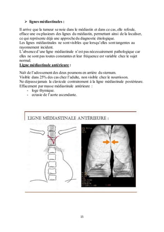 15
 lignes médiastinales :
Il arrive que la tumeur se noie dans le médiastin et dans ce cas, elle refoule,
efface une ou plusieurs des lignes du médiastin, permettant ainsi de la localiser,
ce qui représente déjà une approchedu diagnostic étiologique.
Les lignes médiastinales ne sontvisibles que lorsqu’elles sonttangentes au
rayonnement incident.
L’absenced’une ligne médiastinale n’est pas nécessairement pathologique car
elles ne sont pas toutes constantes et leur fréquence est variable chez le sujet
normal.
Ligne médiastinale antérieure :
Naît de l’adossement des deux poumons en arrière du sternum.
Visible dans 25% des cas chez l’adulte, non visible chez le nourrisson.
Ne dépassejamais la clavicule contrairement à la ligne médiastinale postérieure.
Effacement par masse médiastinale antérieure :
- loge thymique.
- ectasie de l’aorte ascendante.
 